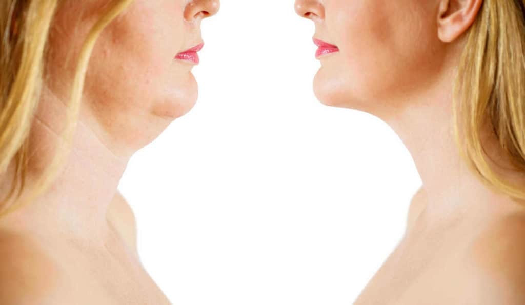 Double Chin treatment Horley before and after results