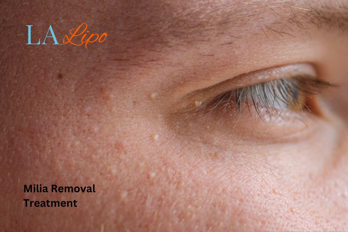 Cryopen Milia Removal: Is It the Easiest and Safest Option Horley?