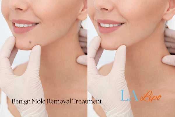 woman's before and after mole removal Horley results