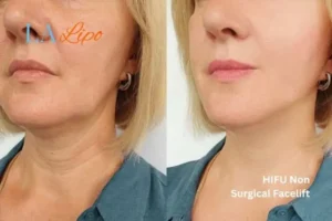 hi-fu for wrinkles Horley before and after results