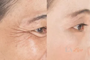 Before and after results of woman - HI-fu wrinkles reduction treatment Horley