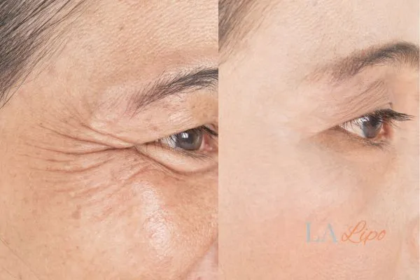 Before and after results of woman - HI-fu wrinkles reduction treatment Horley