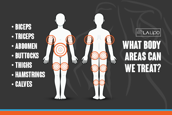 Graphic to show areas you can have LA-EMS Body Sculpting Horley treatment.