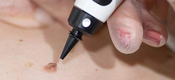 skin tag removal using cryopen Horley
