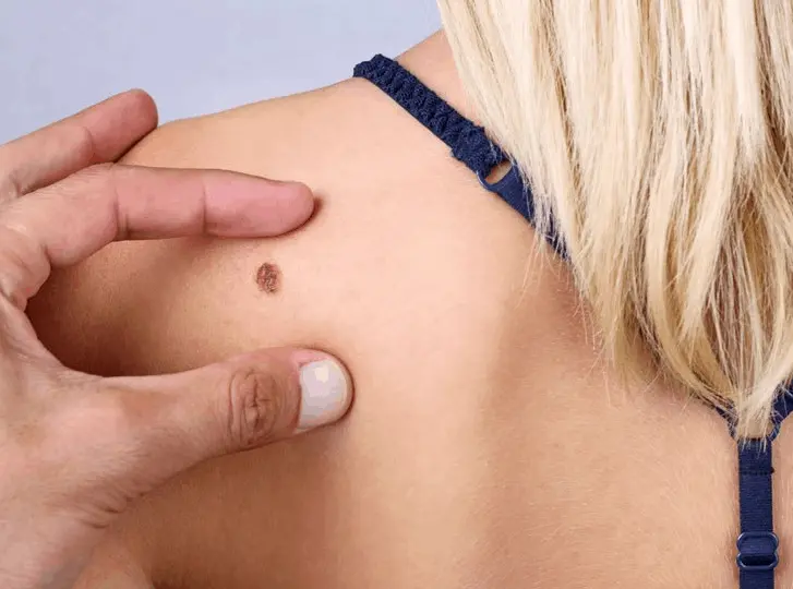 woman having mole removal Horley consultation before treatment.