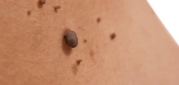 image of a skin tag Horley