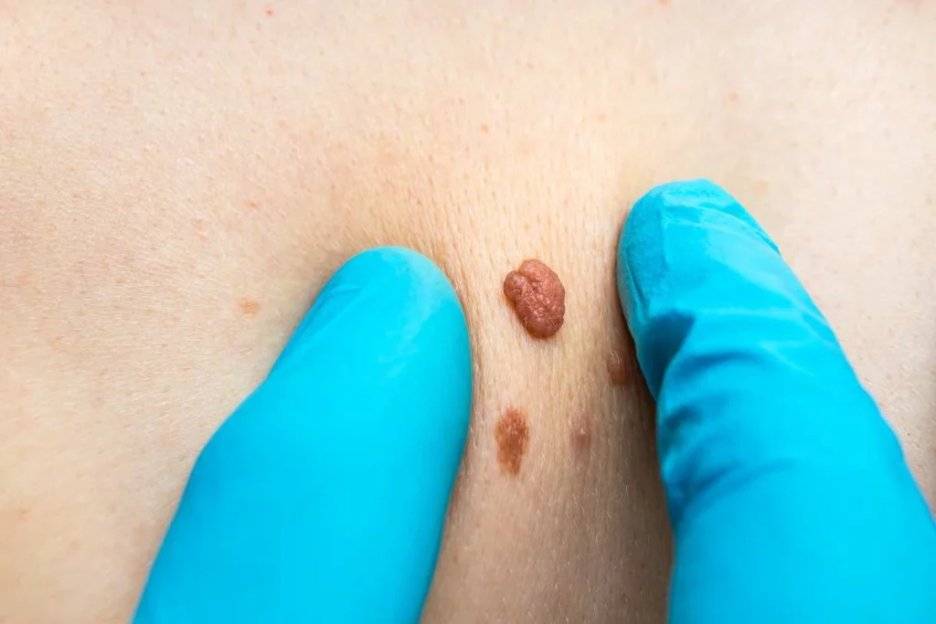 Consultant examining a skin tag Horley