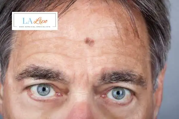 Solar Lentigo Removal Horley image of man with mark on his forehead