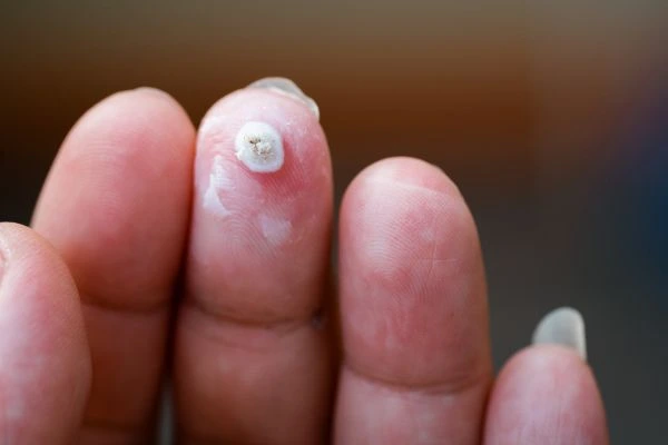 wart on person finger - cryotherapy to treat from LA LIPO Horley
