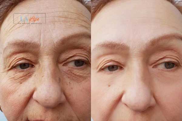 The powerful benefits of Morpheus8 Treatment Horley - Call Our team today!