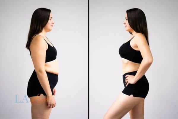 Picture of womans before and after using LA-EMS body sculpting to improve her core strength Horley