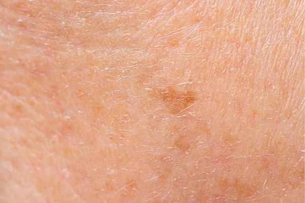 close up picture of age spots Horley