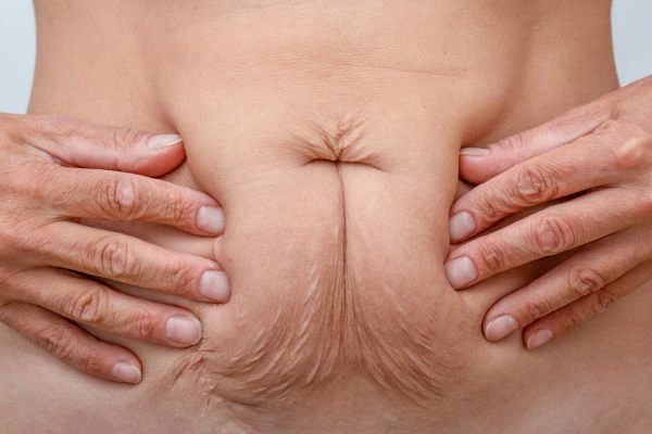 Image of a woman's stomach with loose skin - example of skin tightening Horley options