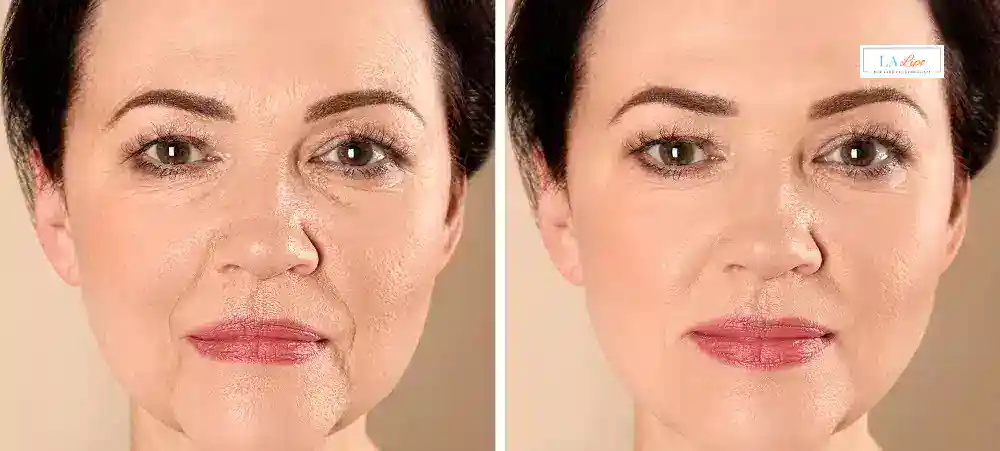 How Long Does It Take to See Results and How Long Do They Last Horley?