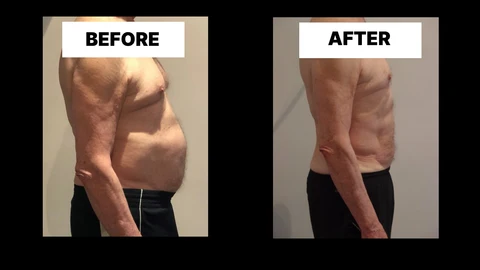 What Symptoms Can Diastasis Recti Cause in Men? Weak Core, Back Pain and Poor Posture Horley